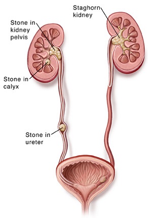 Causes of kidney stone pain