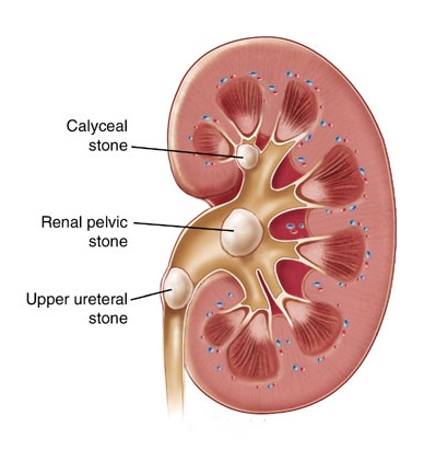 What are kidney stones?